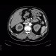 Diverticular bleeding, embolisation: CT - Computed tomography